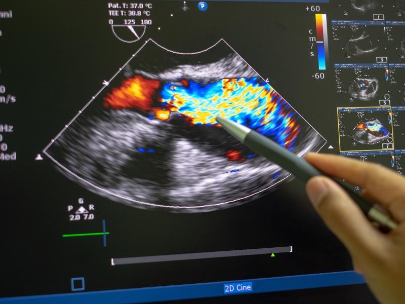 Ultrassom Doppler da Aorta e Artérias Iliacas
